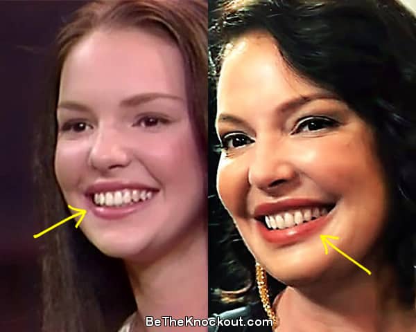 Katherine Heigl teeth before and after comparison photo