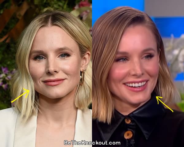 Kristen Bell botox before and after comparison photo