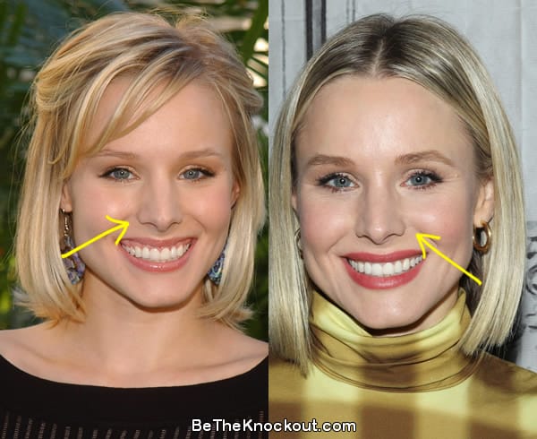 Kristen Bell nose job before and after comparison photo