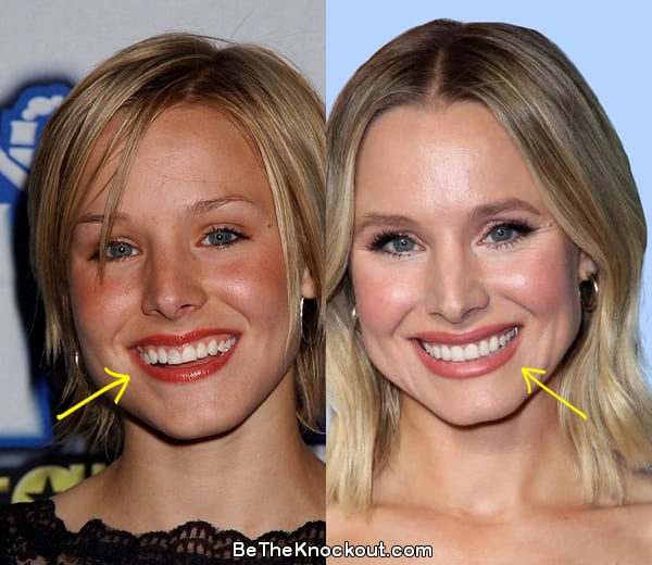 Kristen Bell teeth before and after comparison photo