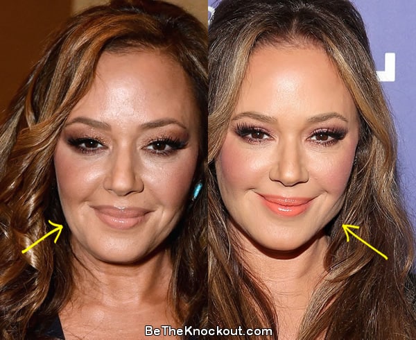 Leah Remini facelift before and after comparison photo