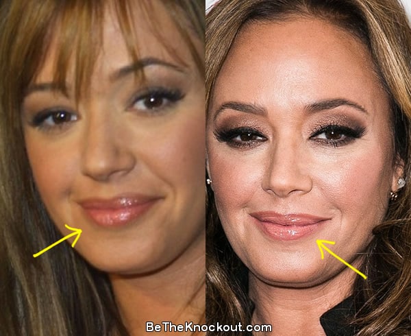Leah Remini lip injections before and after comparison photo