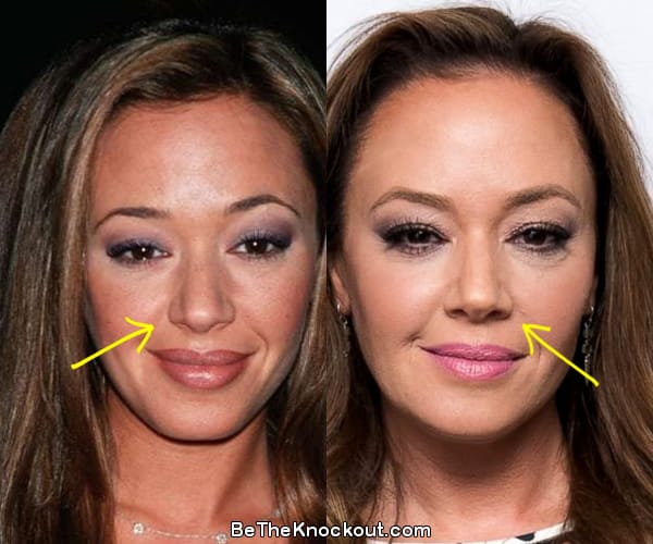 Leah Remini nose job before and after comparison photo
