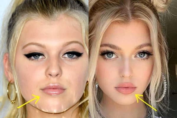 Loren Gray lip fillers before and after comparison photo