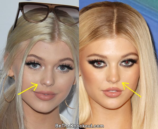 Loren Gray nose job before and after comparison photo