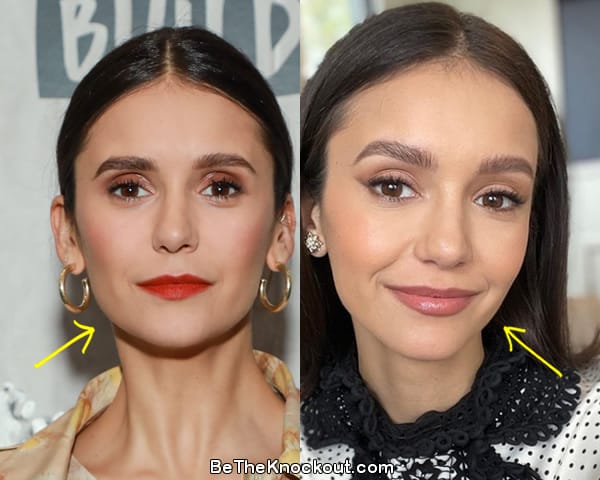 Nina Dobrev botox before and after comparison photo