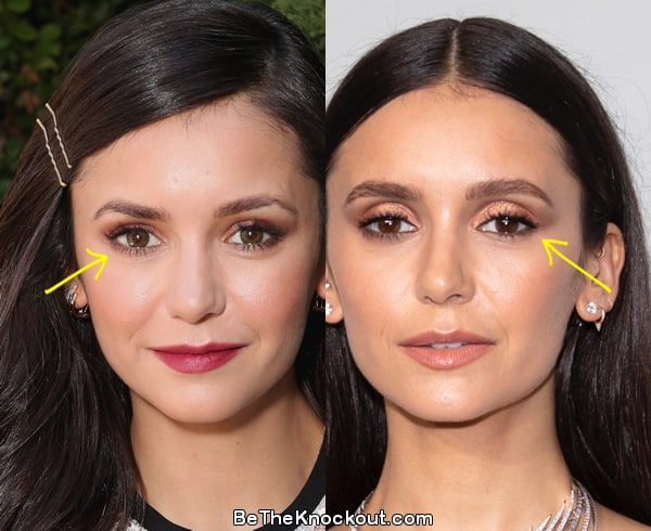Nina Dobrev eyelid surgery before and after comparison photo