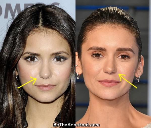 Nina Dobrev nose job before and after comparison photo