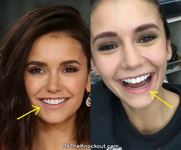 Nina Dobrev teeth before and after comparison photo
