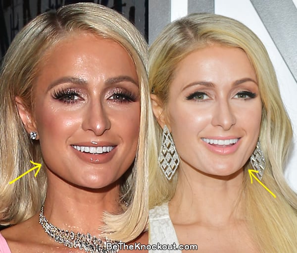 Paris Hilton botox before and after comparison photo