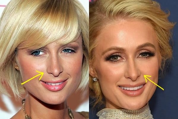 Paris Hilton Plastic Surgery Comparison Photos
