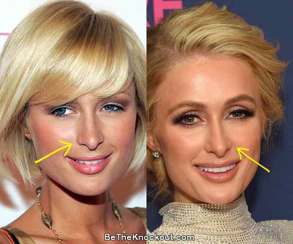 Paris Hilton nose job before and after comparison photo