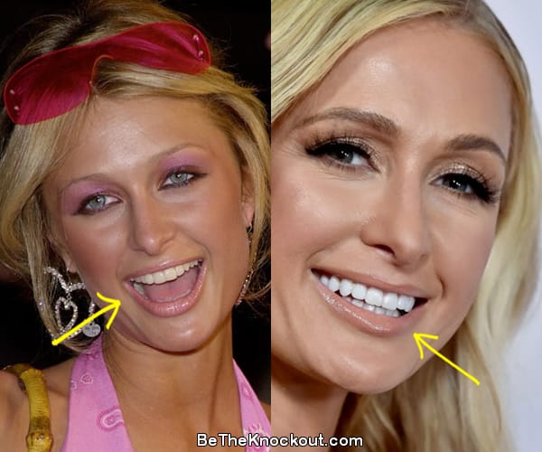 Paris Hilton teeth before and after comparison photo
