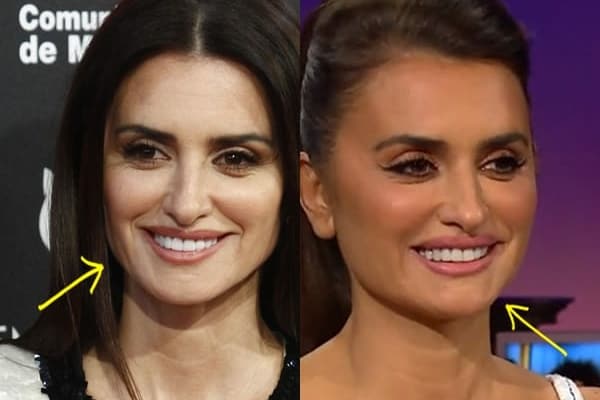 Penelope Cruz botox before and after comparison photo