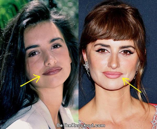 Penelope Cruz lip fillers before and after comparison photo