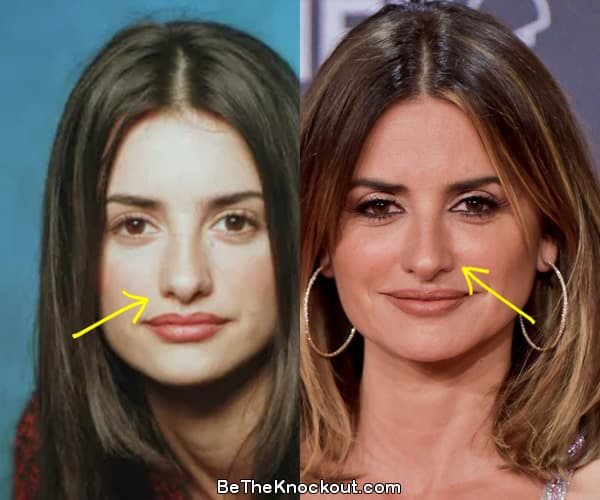 Penelope Cruz nose job before and after comparison photo