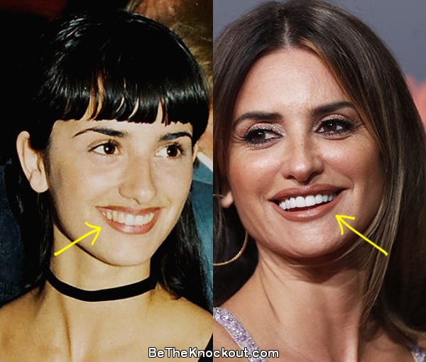 Penelope Cruz teeth before and after comparison photo