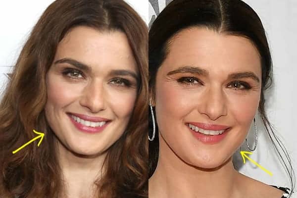 Rachel Weisz botox before and after comparison photo