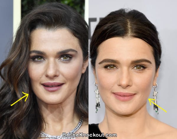 Rachel Weisz facelift before and after comparison photo