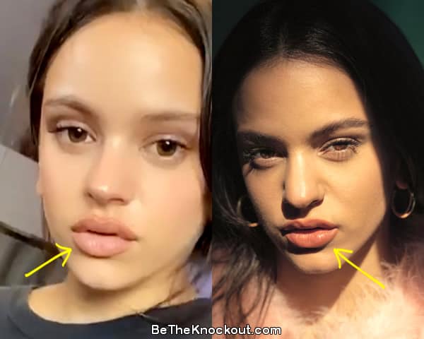 Rosalia lip injections before and after comparison photo